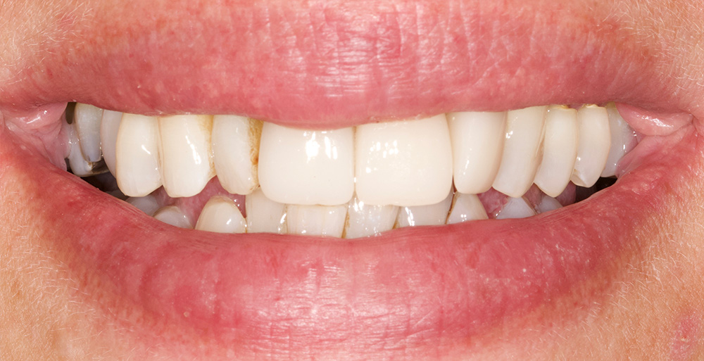 Ceramic Veneers - After