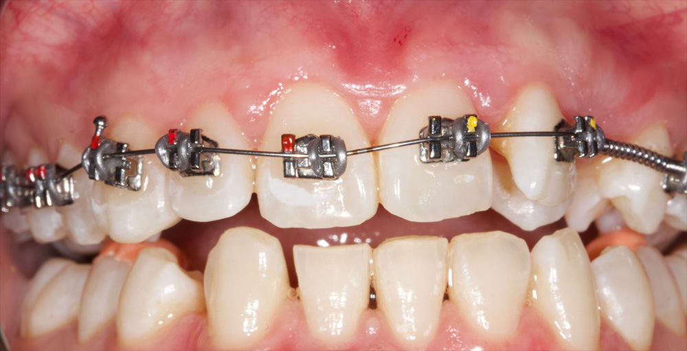 Fixed Braces - Before