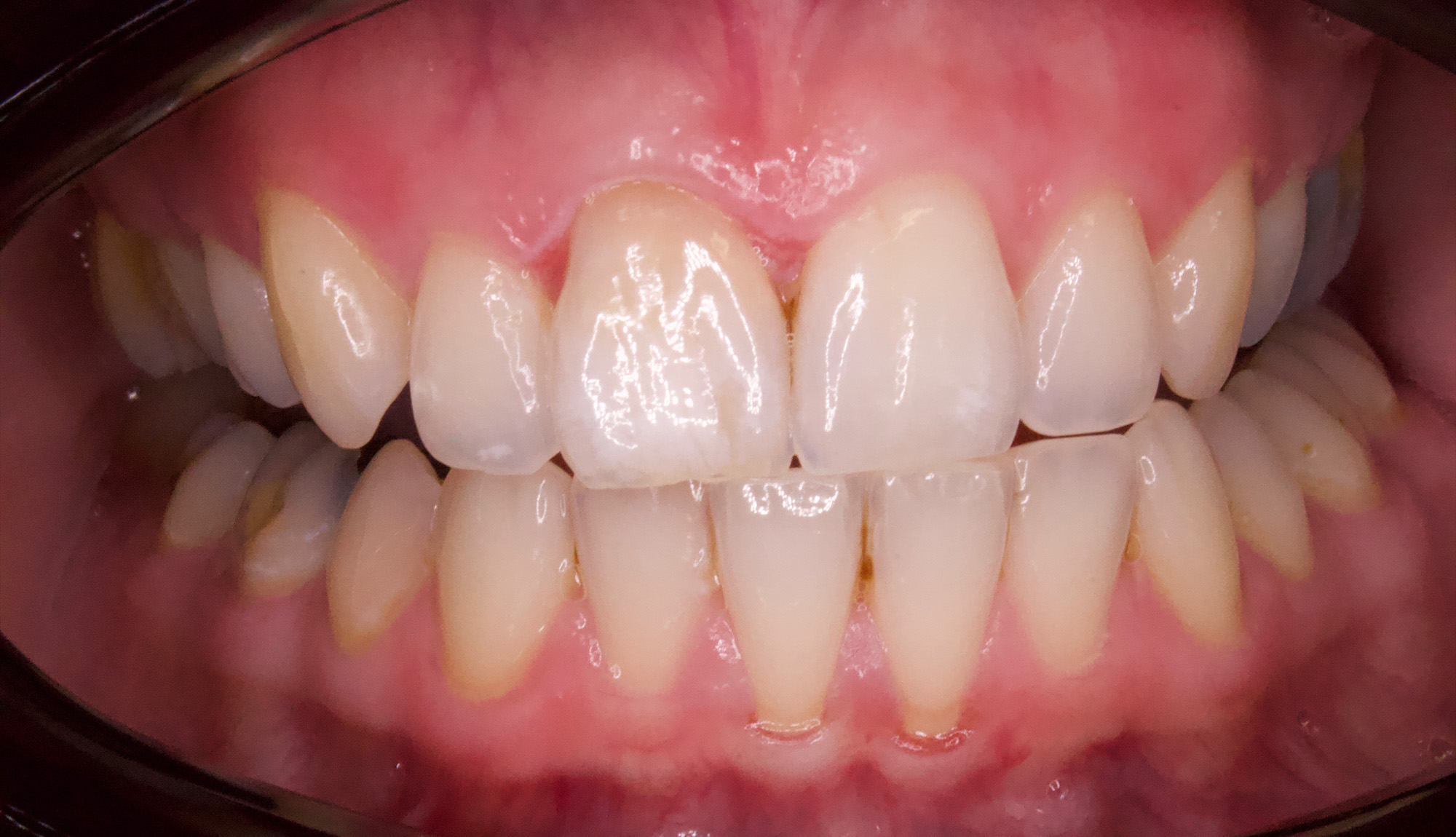 Whitening of Dark/Trauma tooth - Free-hand composite bonding - after