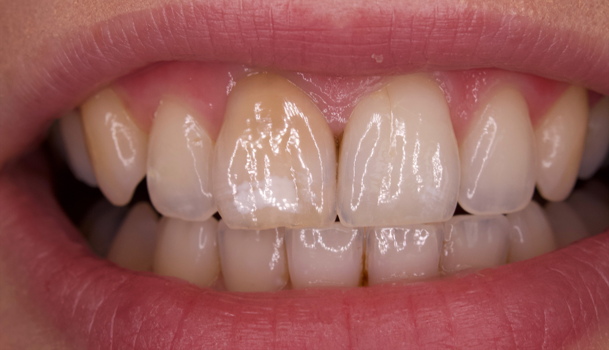 Whitening of Dark/Trauma tooth - Free-hand composite bonding - before